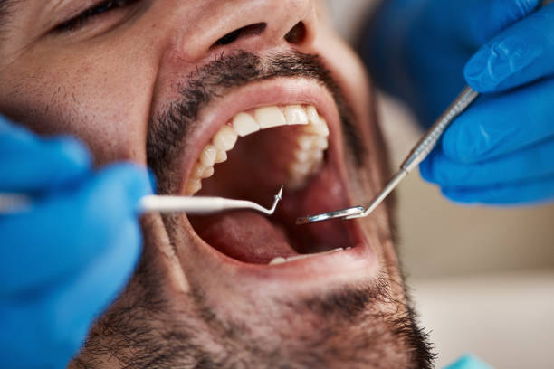 Best Emergency Dentist for Lost Fillings or Crowns in Winston Salem, NC